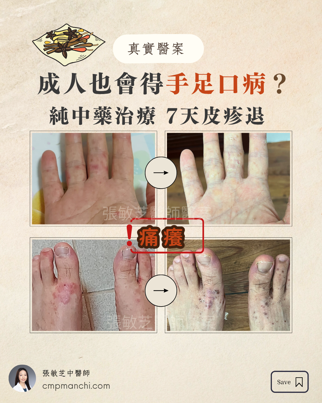【真實醫案】 成人也會得手足口病？純中藥治療 7天皮疹退